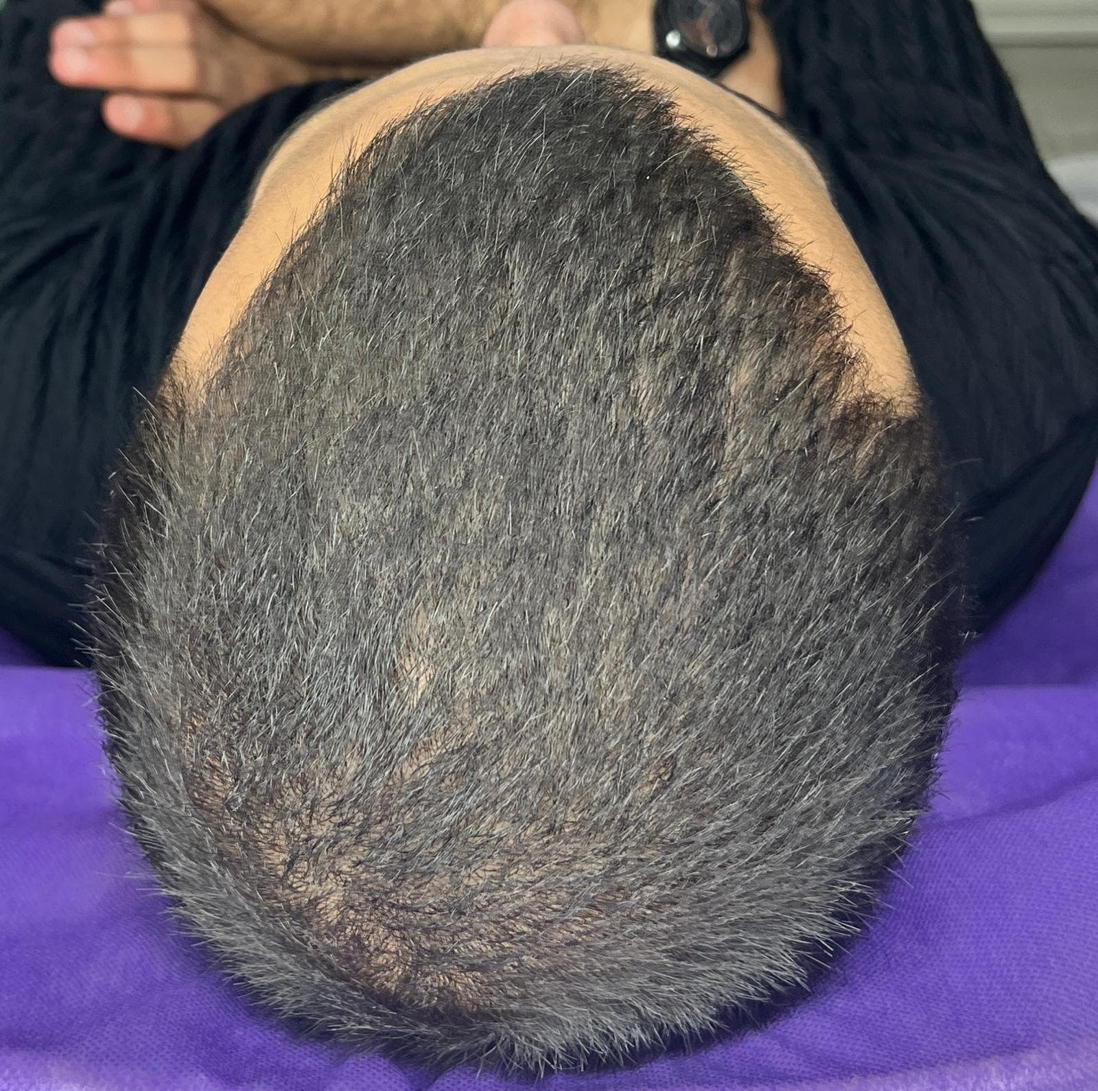 بعد - تساقط الشعر