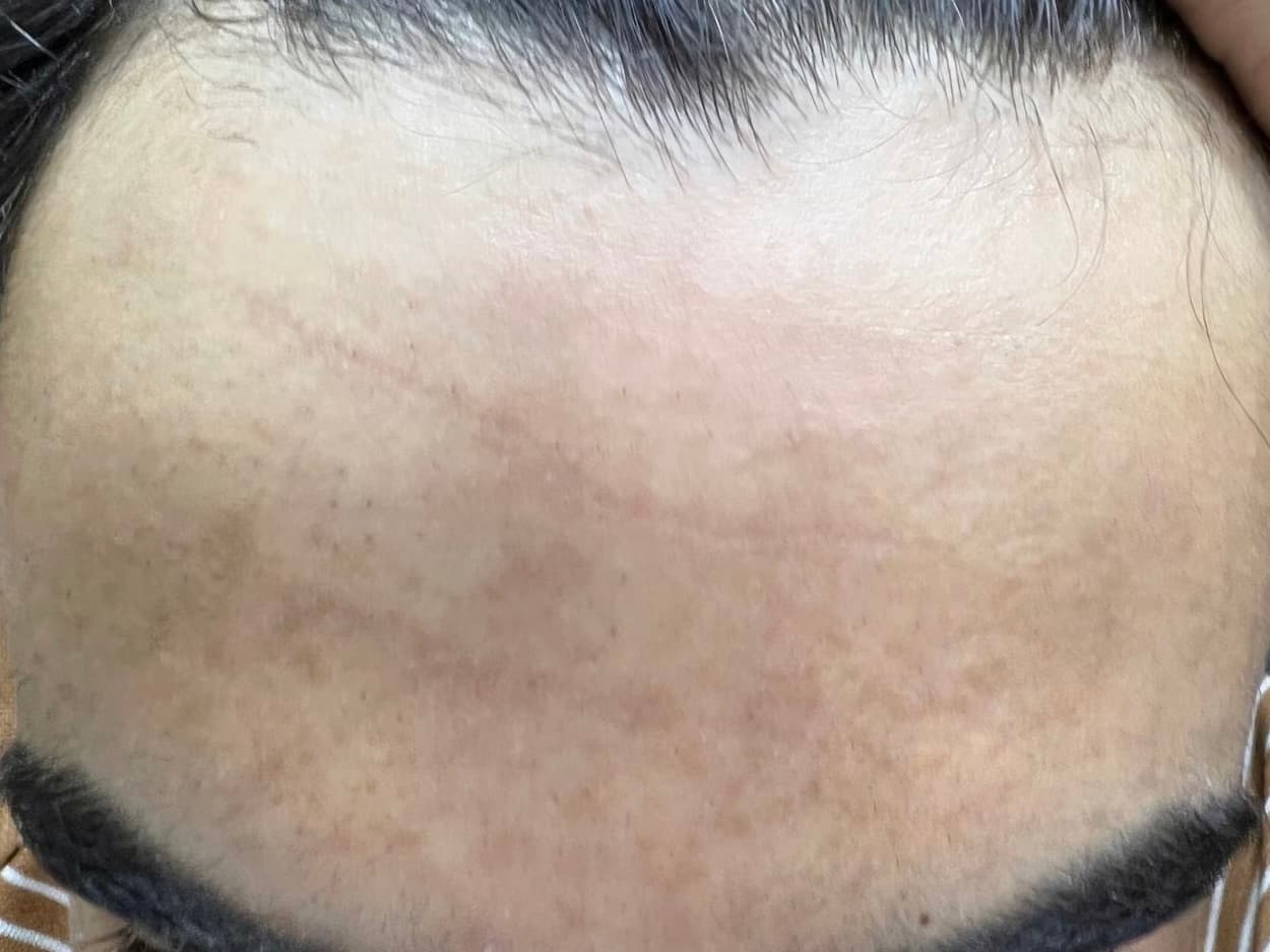 قبل - تصبغات الجبين