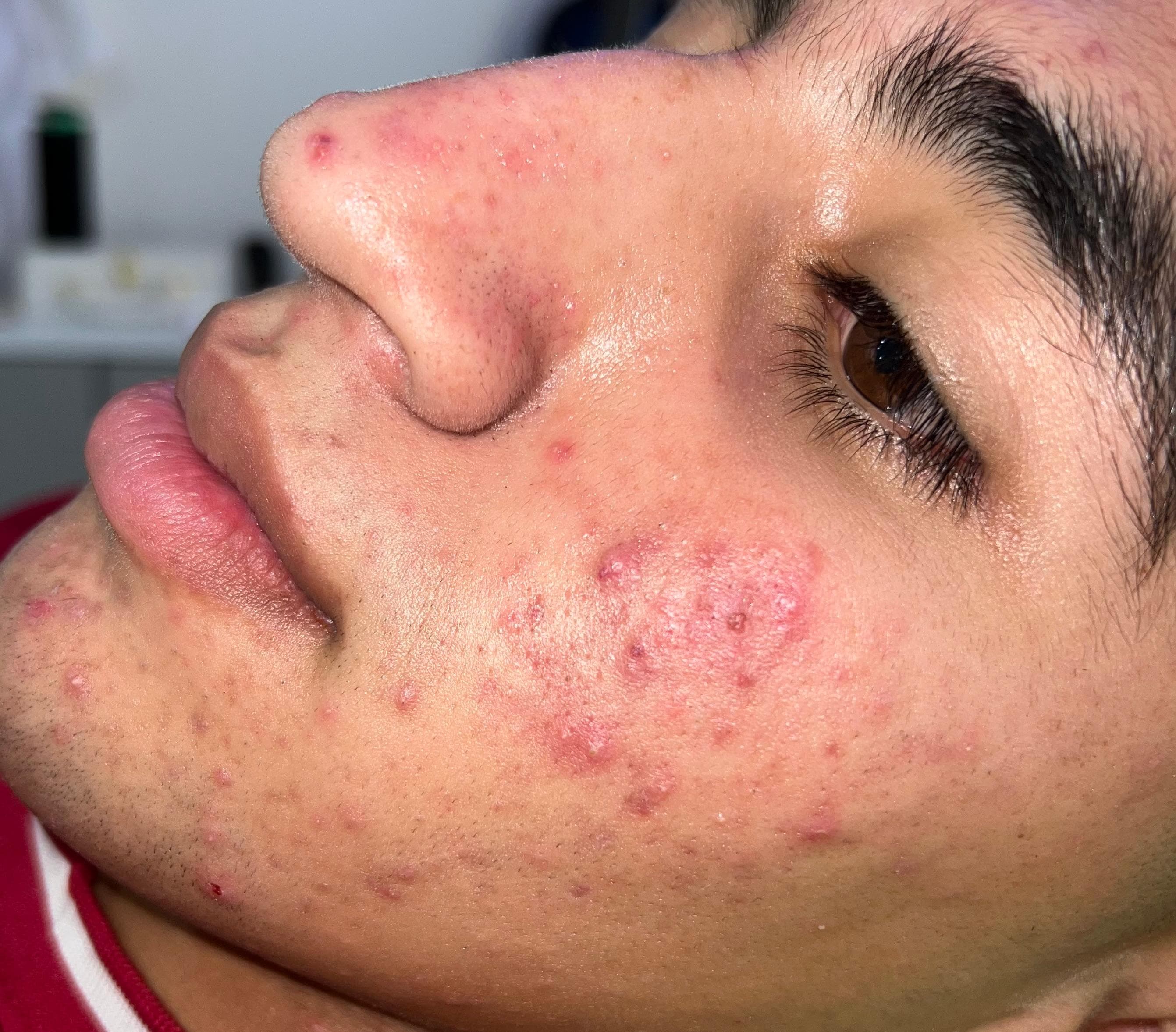 بعد - تصفية البشرة