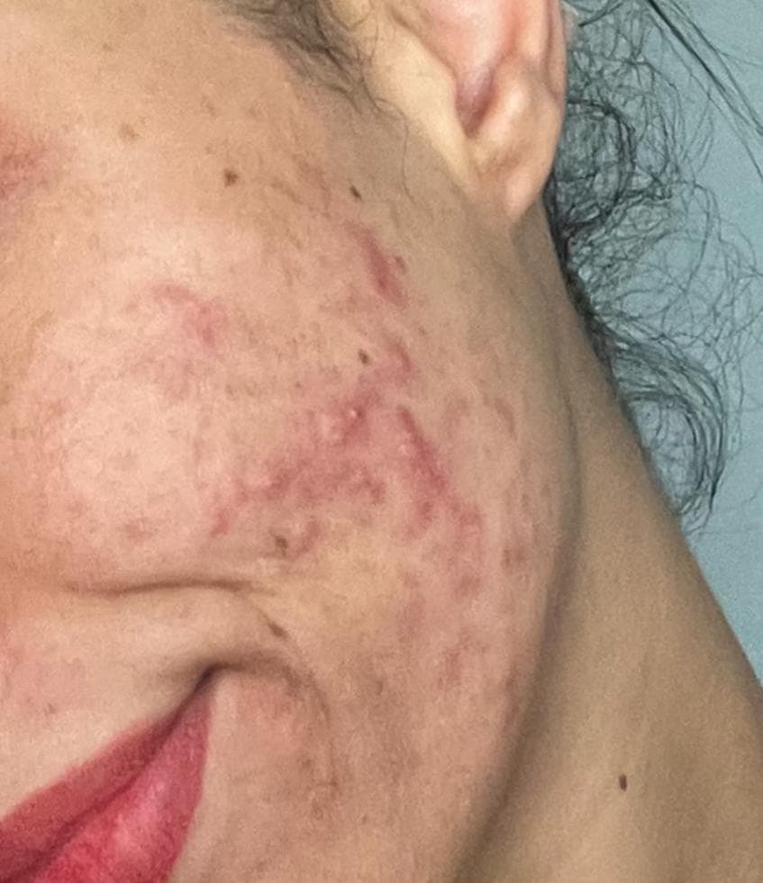 Before - Acne Treatment