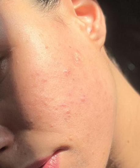 After - Acne Treatment