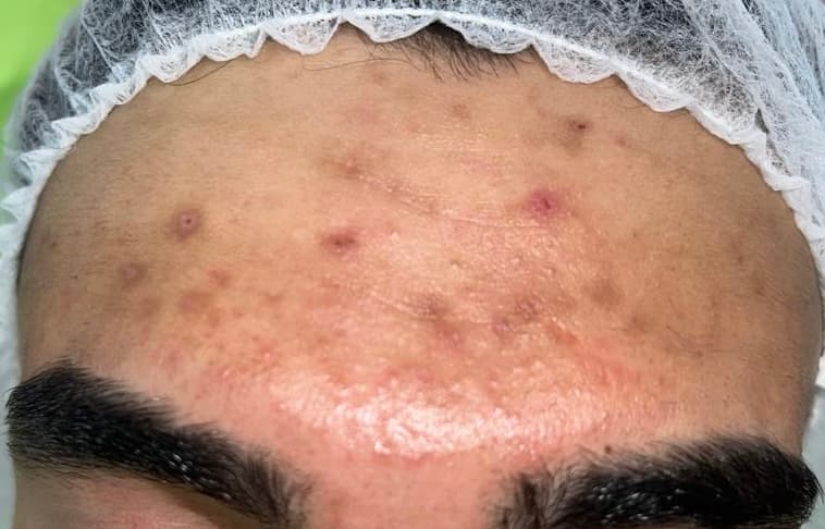 Before - Pigmentation